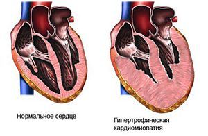 Что такое кардиомиопатия