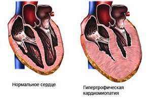 Кардиомиопатия