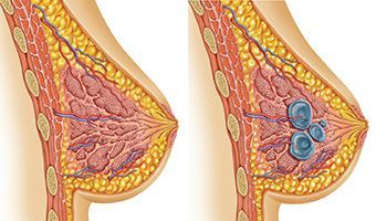 Киста молочной железы