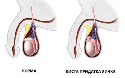 Лечение кисты придатка яичка