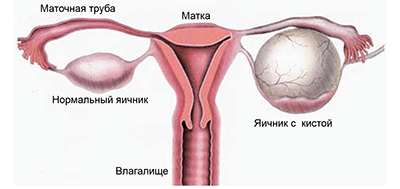 Кисты и опухоли яичников