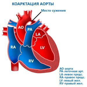 Коарктация аорты