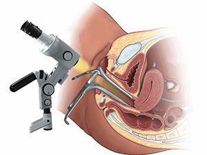 Кольпоскопия