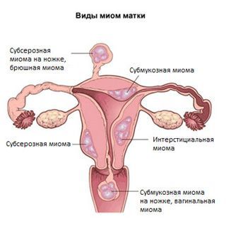 Реферат: Фибромиома матки 2