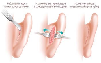 Коррекция ушных раковин