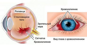 Кровоизлияние в глаз