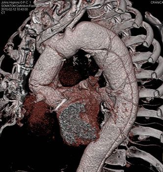КТ грудного отдела аорты