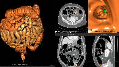 Компьютерная томография кишечника