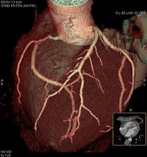 КТ-коронарография сосудов сердца