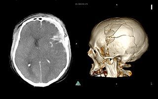 Компьютерная томография костей черепа