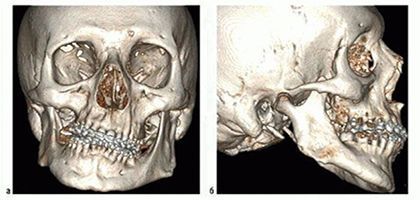 КТ костей лицевого скелета 