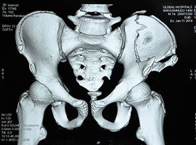 КТ костей малого таза