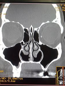 Компьютерная томография пазух носа