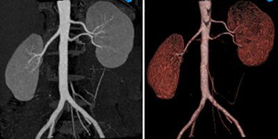 КТ почечных артерий и скрининговое исследование почек