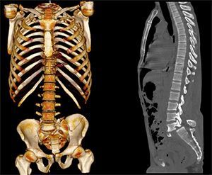 Компьютерная томография позвоночника