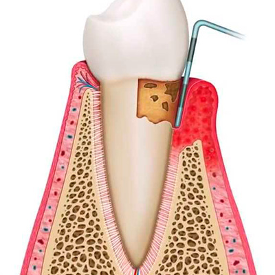Кюретаж пародонтальных карманов