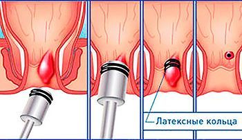 Латексное лигирование геморроидальных узлов