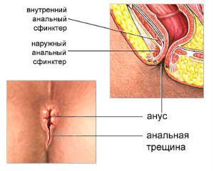 Анальная трещина, лечение острой и хронической анальной трещины, причины  трещины анального прохода.