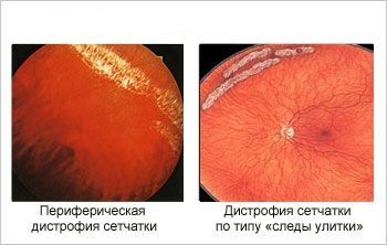 Лечение дистрофии сетчатки