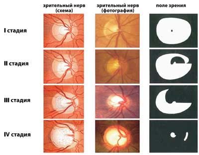 Стадии глаукомы