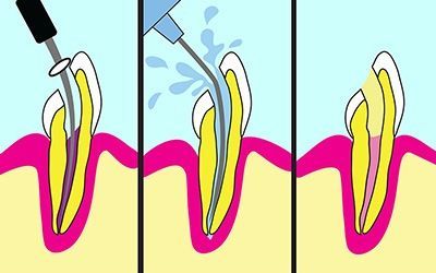 Лечение каналов зуба