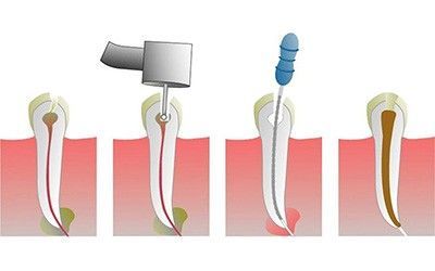 Лечение каналов зуба