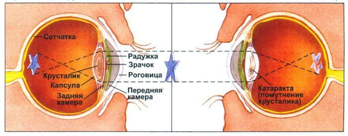 лечение катаракты