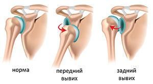 Лечение нестабильности плечевого сустава, повреждения Банкарта