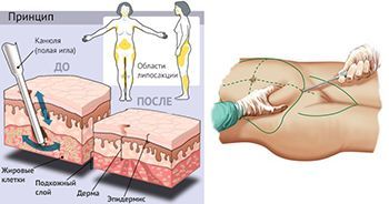 Липосакция