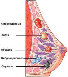 Заболевания молочных желез