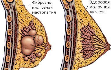 Мастопатия