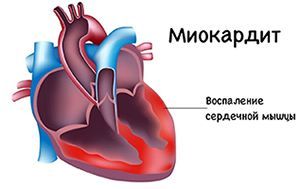 Миокардит симптомы, причины и диагностика. Лечение миокардита в многопрофильной клинике ЦЭЛТ.