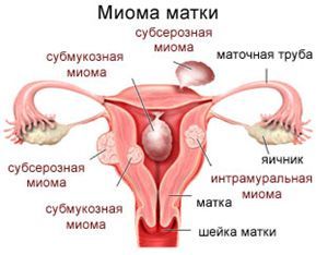 Миома матки мне поставили диагноз Миома матки мне поставили диагноз thumbnail