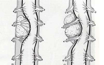 Множественные опухоли позвоночного канала