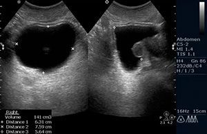 УЗИ мочевого пузыря