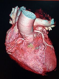 Мультиспиральная компьютерная томография коронарных артерий