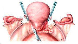 Надвлагалищная ампутация матки