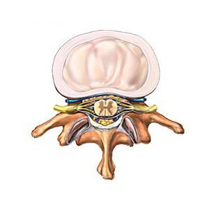 Протрузия дисков поясничного отдела позвоночника