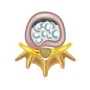 Протрузия дисков шейного отдела