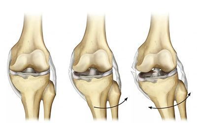 Нестабильность коленного сустава