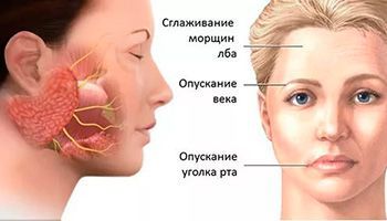 Невропатия лицевого нерва
