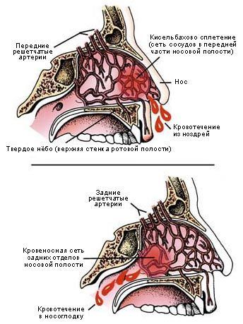 Носовое кровотечение у детей