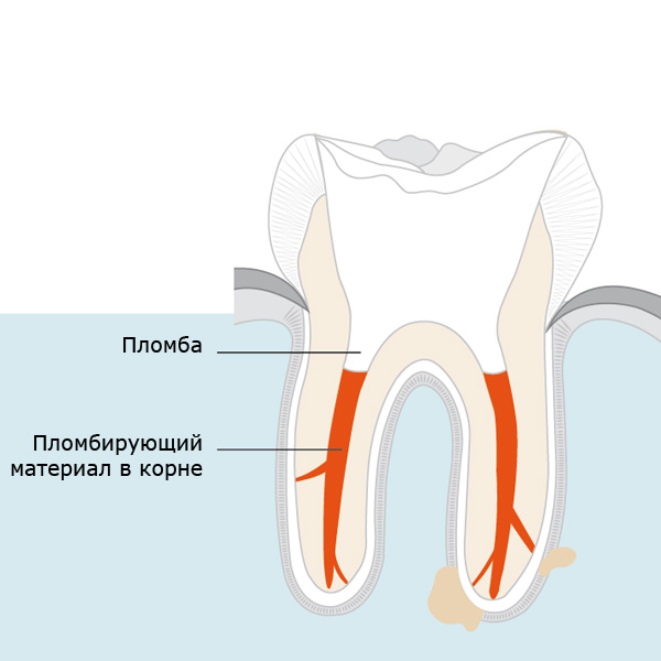 Обтурация корневого канала