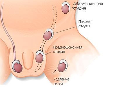 Операция при крипторхизме