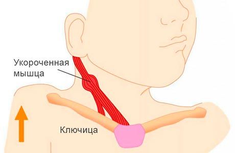 Операция при кривошее