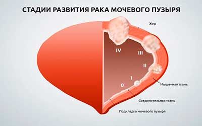 Опухоль мочевого пузыря