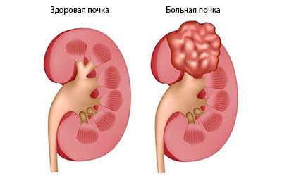 Диагностика опухолей лоханки почки и мочеточника