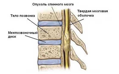 Опухоли спинного мозга