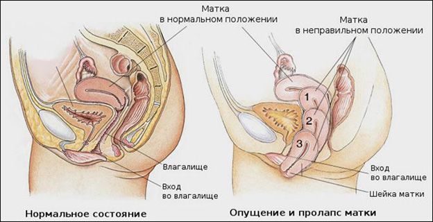 Стадии опущения матки