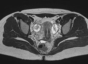 МРТ органов малого таза